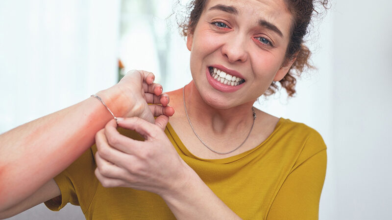 Girl Facing Iching Due to Prurigo Nodularis