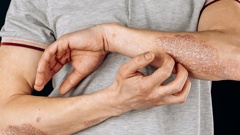 Asteatotic Eczema