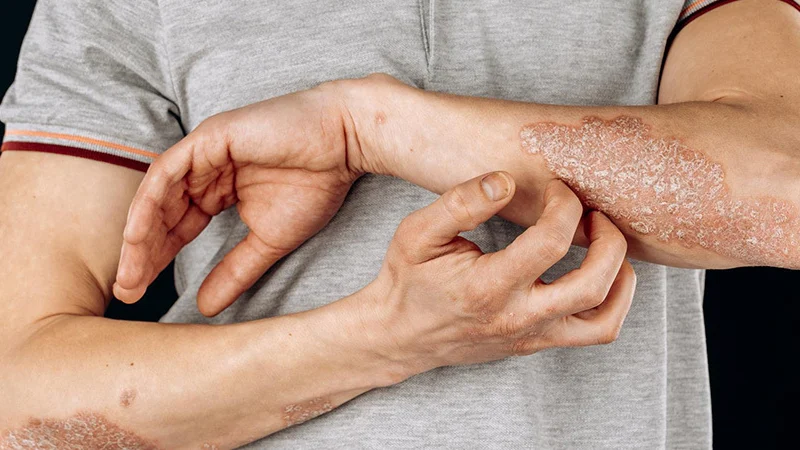 Asteatotic Eczema