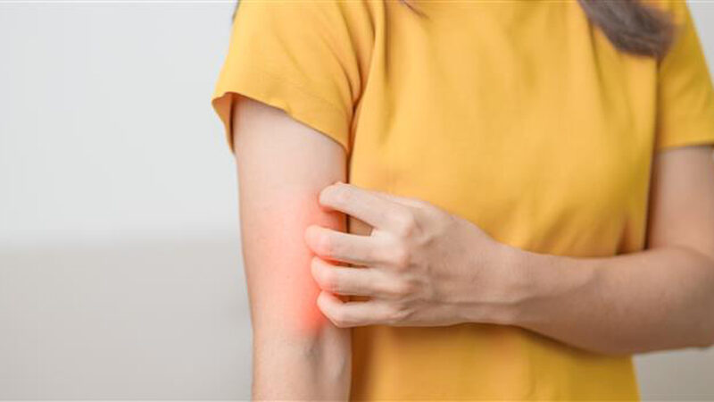 Prurigo Nodularis Treatment