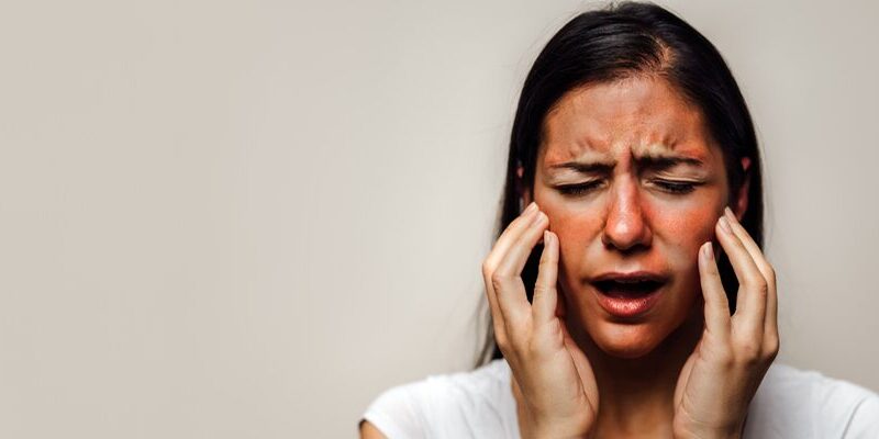 Discoid Lupus