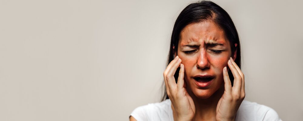 Discoid Lupus