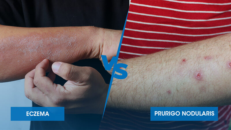 Prurigo Nodularis vs Eczema