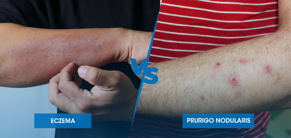 Prurigo Nodularis vs Eczema