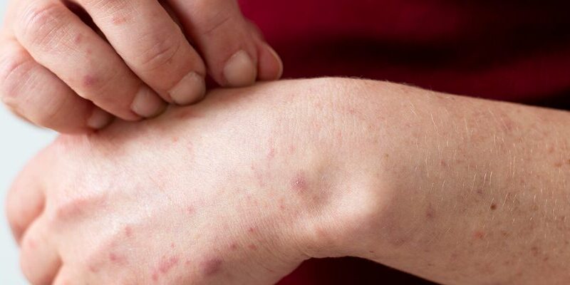 is prurigo nodularis an autoimmune disease