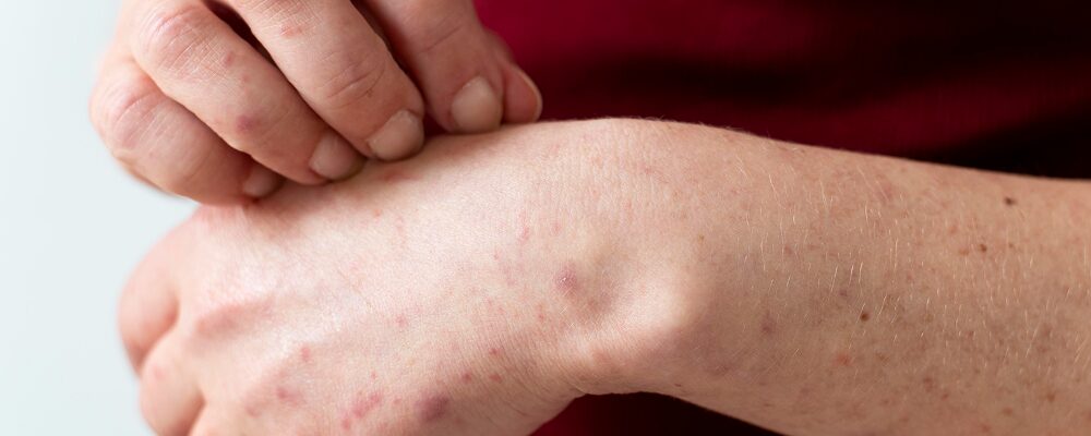 is prurigo nodularis an autoimmune disease